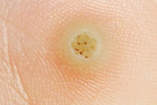 Infectia cu virusul papiloma uman (HPV) | hotatelescopica.ro