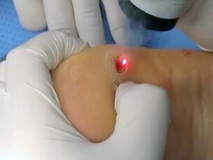 Tratament cu laser pentru negi