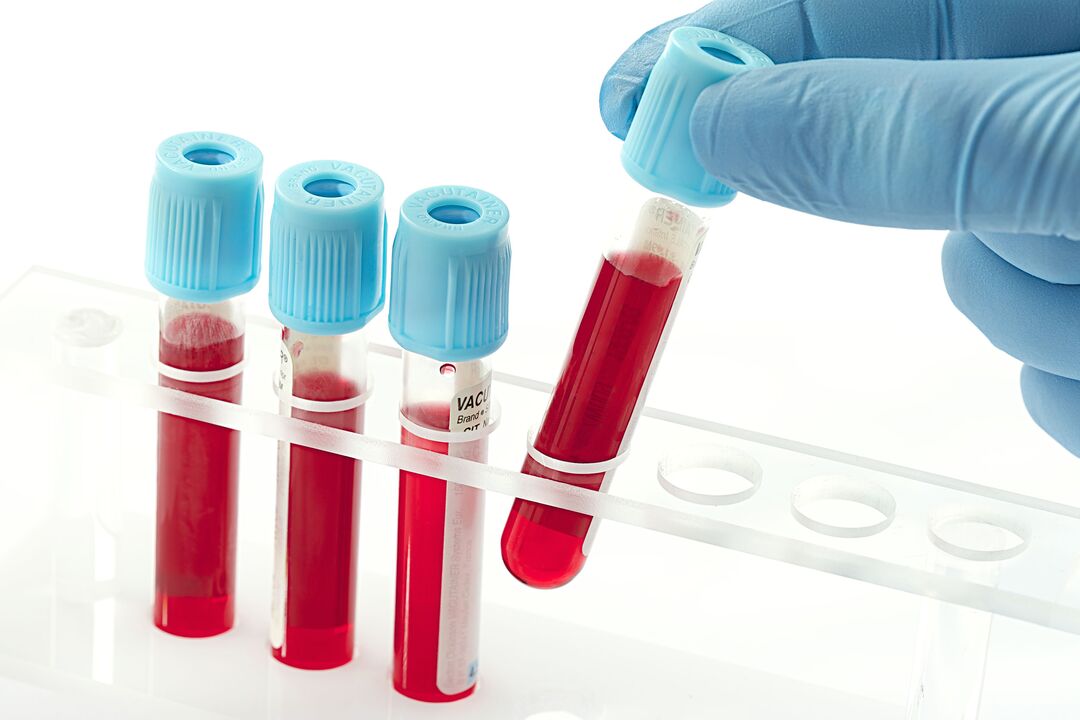 Test de sânge pentru a diagnostica virusul papiloma uman