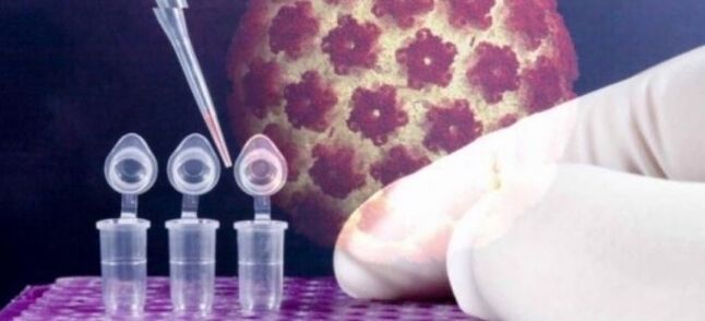 Diagnosticarea HPV cu testul Digene